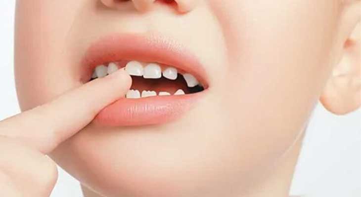 کج درآمدن دندان دائمی کودکان