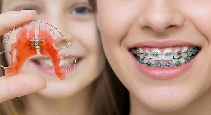 تفاوت ارتودنسی پیشگیری با ارتودنسی معمولی