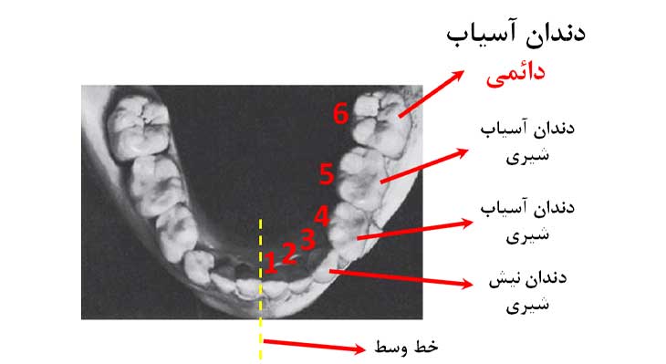 دندان شماره ۶ یا اولین دندان دائمی کودک