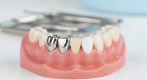 روکش فلزی دندان کودکان یا روکش سفید؟
